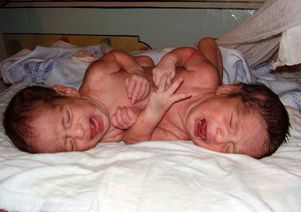 Докторы в Италии готовятся к операции по разделению сиамских близнецов