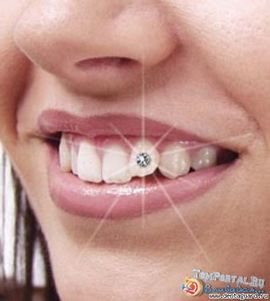 Пирсинг на языке вредоносен для зубного здоровья