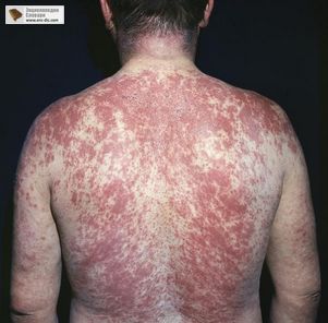 Аллергия: симптомы и лечение
