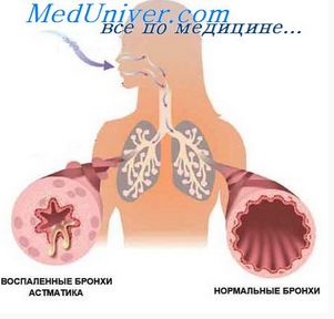 Вещества из фруктов заменят лекарства против астмы