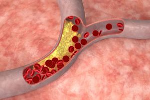 Уровень трех веществ в крови человека расскажет о риске инфаркта
