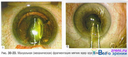Изучение распространенности псевдоэксфолиативной глаукомы в отдельных областях Центрального региона России
